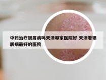 中药治疗银屑病吗天津哪家医院好 天津看银屑病最好的医院