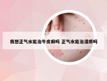 我想正气水能治牛皮癣吗 正气水能治湿疹吗