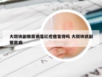 大斑块副银屑病是红疙瘩变得吗 大斑块状副银屑病