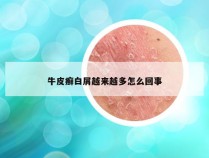 牛皮癣白屑越来越多怎么回事