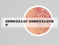 皮肤癣应该怎么治疗 皮肤癣应该怎么治疗最好