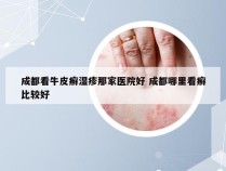 成都看牛皮癣湿疹那家医院好 成都哪里看癣比较好