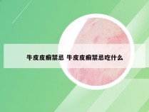 牛皮皮癣禁忌 牛皮皮癣禁忌吃什么