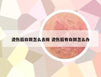 烫伤后白斑怎么去除 烫伤后有白斑怎么办