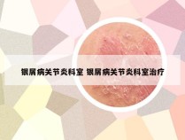 银屑病关节炎科室 银屑病关节炎科室治疗