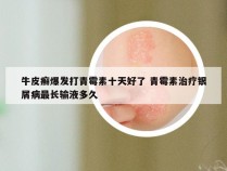 牛皮癣爆发打青霉素十天好了 青霉素治疗银屑病最长输液多久