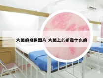 大腿癣症状图片 大腿上的癣是什么癣