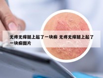 无疼无痒腿上起了一块癣 无疼无痒腿上起了一块癣图片