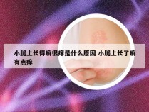 小腿上长得癣很痒是什么原因 小腿上长了癣有点痒