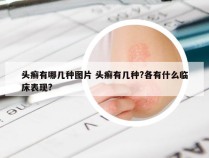 头癣有哪几种图片 头癣有几种?各有什么临床表现?