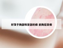 好发于胸部和背部的癣 前胸后背癣