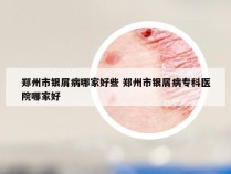 郑州市银屑病哪家好些 郑州市银屑病专科医院哪家好