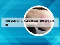 银屑病通过什么方式能够确诊 银屑病怎么诊断