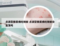 点滴型银屑病吃辣椒 点滴型银屑病吃辣椒会复发吗