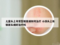 儿童头上寻常型银屑病如何治疗 小孩头上有银屑头病好治疗吗