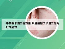 牛皮癣卡泊三醇效果 银屑病擦了卡泊三醇为好久起效