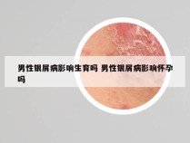 男性银屑病影响生育吗 男性银屑病影响怀孕吗