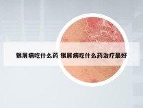 银屑病吃什么药 银屑病吃什么药治疗最好