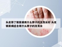 头皮得了银屑病用什么牌子的洗发水好 头皮银屑病适合用什么牌子的洗发水