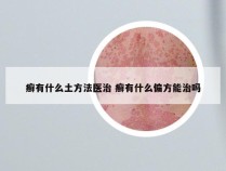 癣有什么土方法医治 癣有什么偏方能治吗