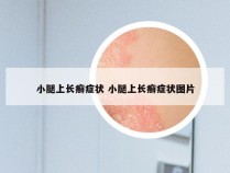 小腿上长癣症状 小腿上长癣症状图片