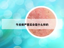 牛皮癣严重后会是什么样的