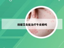 拔罐艾灸能治疗牛皮癣吗