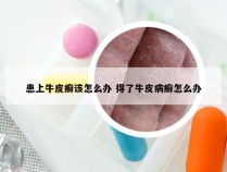 患上牛皮癣该怎么办 得了牛皮病癣怎么办