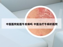 中医医院能医牛皮癣吗 中医治疗牛癣的医院