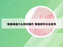 银翘病是什么样的图片 银翘病可以治愈吗