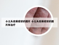 小儿头皮癣症状的图片 小儿头皮癣症状的图片和治疗