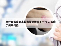 为什么长辈身上长癣能遗传给下一代 人长癣了传不传染