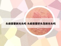 头癣需要剃光头吗 头癣需要把头发剃光头吗