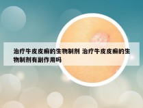 治疗牛皮皮癣的生物制剂 治疗牛皮皮癣的生物制剂有副作用吗