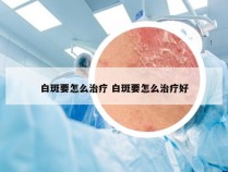 白斑要怎么治疗 白斑要怎么治疗好