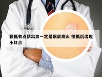 骚抓有点状出血一定是银屑病么 搔抓后出现小红点