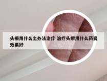 头癣用什么土办法治疗 治疗头癣用什么药膏效果好