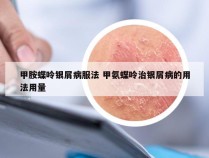 甲胺蝶呤银屑病服法 甲氨蝶呤治银屑病的用法用量