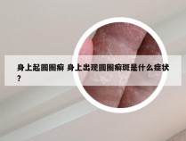 身上起圆圈癣 身上出现圆圈癣斑是什么症状?