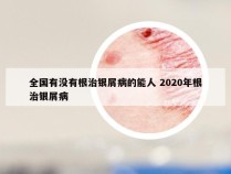 全国有没有根治银屑病的能人 2020年根治银屑病