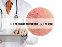 小儿牛皮癣始发症状图片 小儿牛皮廨