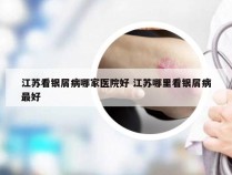 江苏看银屑病哪家医院好 江苏哪里看银屑病最好