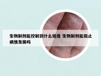 生物制剂能控制到什么程度 生物制剂能阻止病情发展吗