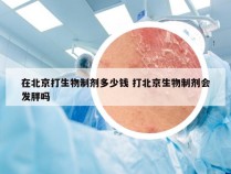 在北京打生物制剂多少钱 打北京生物制剂会发胖吗