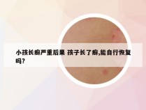 小孩长癣严重后果 孩子长了癣,能自行恢复吗?