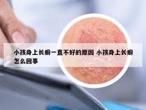 小孩身上长癣一直不好的原因 小孩身上长癣怎么回事