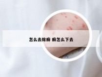 怎么去除癣 癣怎么下去