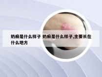 奶癣是什么样子 奶癣是什么样子,主要长在什么地方