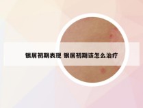 银屑初期表现 银屑初期该怎么治疗