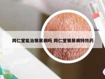 同仁堂能治银屑病吗 同仁堂银屑病特效药